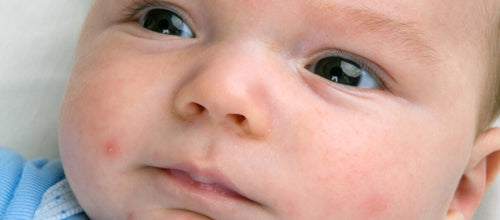 Votre bébé a la peau fragile : nos solutions aux problèmes les plus fréquents